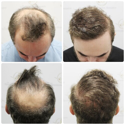Dr Bonaros, Glasgow, UK / 3986 FUE grafts / 0-12 Months photo
