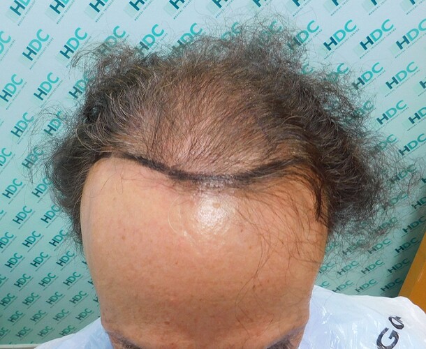 Hair Transplant Outcome with 4000 Grafts Across NW5 Zone – HDC Hair Clinic photo