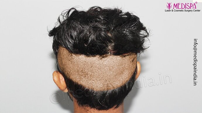 Dr. Suneet Soni - 3029 FUE Grafts, FUE Method (Trivellini System), NW - III photo