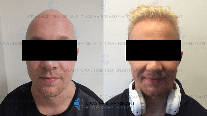 Civas Hair Transplant- FUE Hair Transplant Before & After Pictures (3500 Grafts) photo