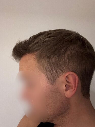 Ozlem Bicer MD-Hair Transplant-2720 Grafts FUE by micro-motor, 9. months result photo