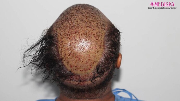 11600 Grafts in 3 FUT Sittings by Dr Suneet Soni photo