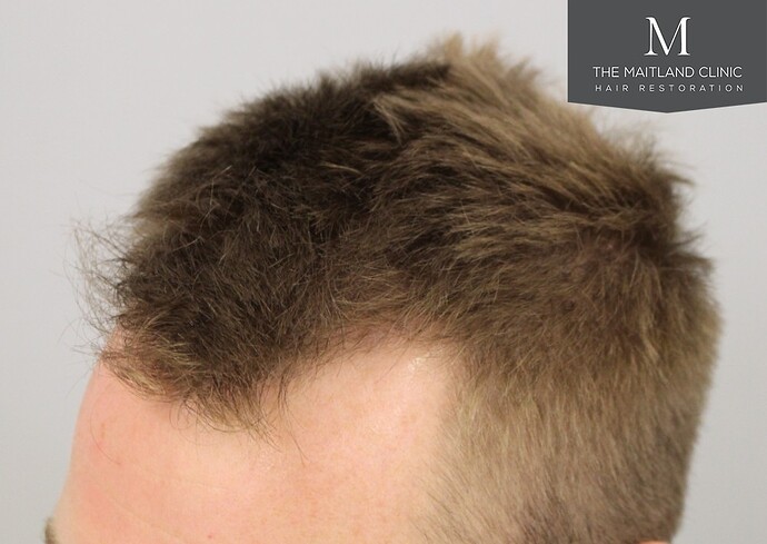 Dr Ball - The Maitland Clinic 1204 Grafts By FUE photo