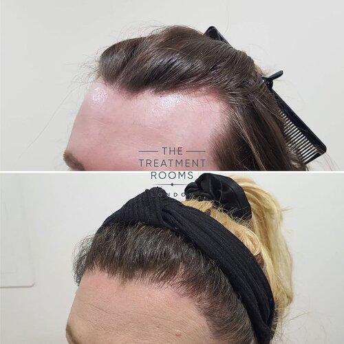 2 Stage FUE Hair Transplant- Hairline Feminisation- 2319 Grafts photo