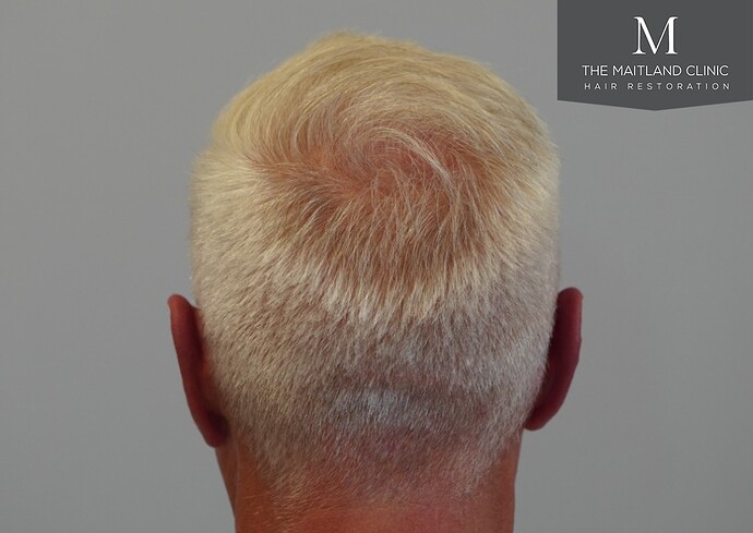 Dr Ball - The Maitland Clinic 2280 Grafts by FUE photo