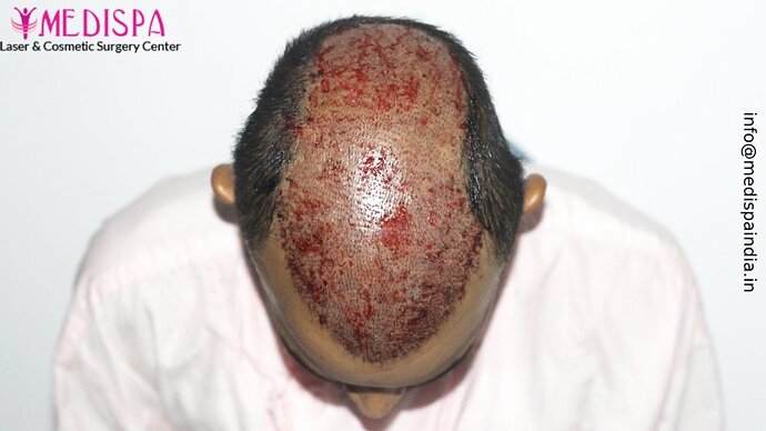 Dr. Suneet Soni - 5294 Grafts, Combine FUT + FUE + Beard Technique, NW- VI, 2 Years Result photo