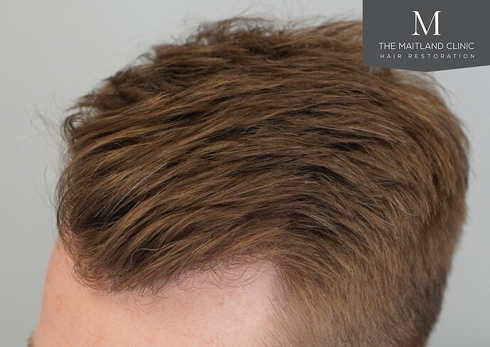 Dr Ball - The Maitland Clinic 1204 Grafts By FUE photo