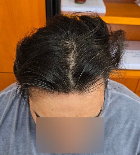 Density Enhancement Result for 4516 FUE Grafts – HDC Hair Clinic – 1 Year Post-Procedure photo