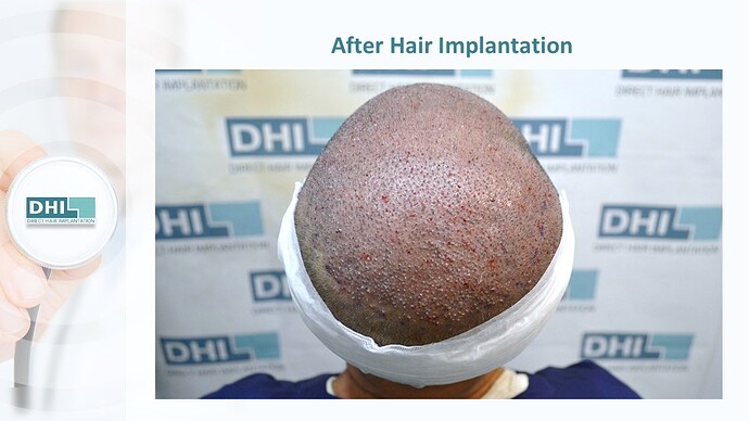 DHI India™ | NW 4 | 3,759 Grafts | 1 year DHI Hair Transplant Results photo
