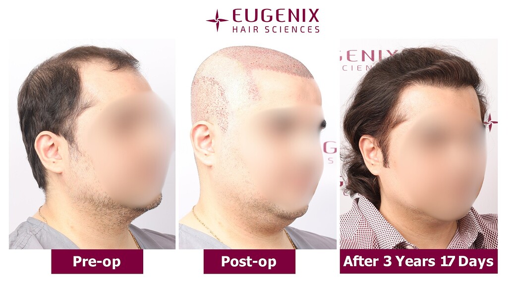 https://cdn.forumhairtransplant.com/optimized/3X/b/0/b09bd7ef74b59a0dceaef6e7e25e95799ae2cac5_2_1035x582.jpeg