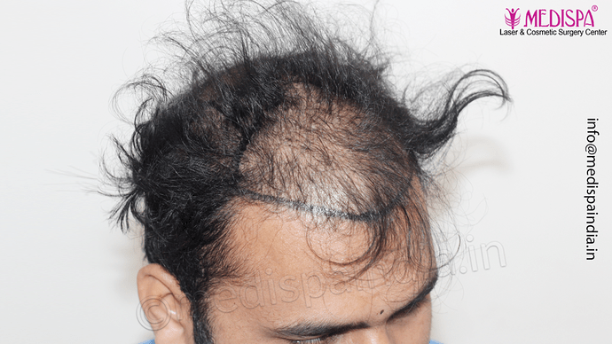 Dr. Suneet Soni - 5467 Grafts, Combine FUT + FUE + Beard Technique, NW- V, 3 Years Result photo