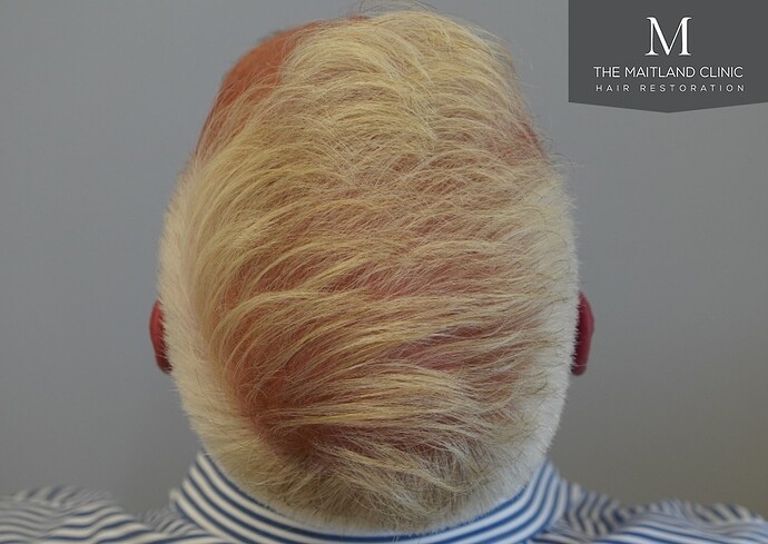 Dr Ball - The Maitland Clinic 2280 Grafts by FUE photo