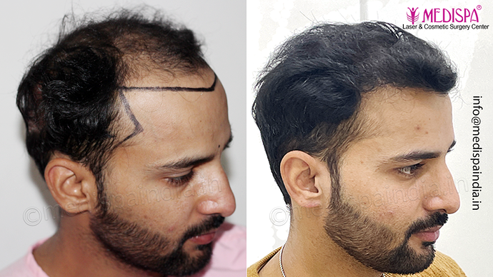 Dr. Suneet Soni - 4046 Grafts | 12-Month Result | Combination FUT + FUE + Beard photo