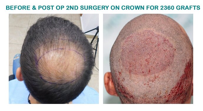 Two FUE Surgeries Totaling 6560 Grafts – HDC Hair Clinic photo