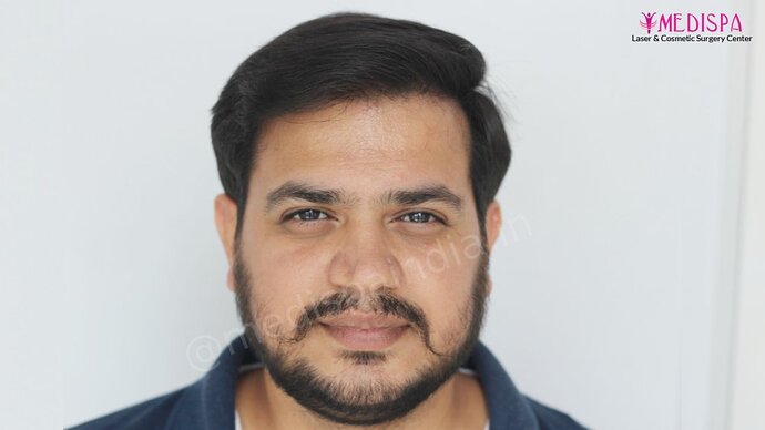 Dr. Suneet Soni - 4937 Grafts, Combine FUT + FUE Technique, NW : IV-V photo