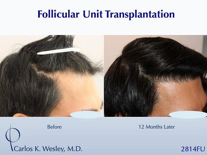 #BAM Stronger, Healthier Hairline (2814 FUT grafts): Carlos K. Wesley, M.D. (NYC & LA) photo