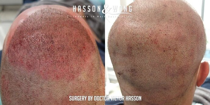 Dr. Hasson / 4,511 grafts / FUE / Frontal zone /mid / 3 years post-op photo