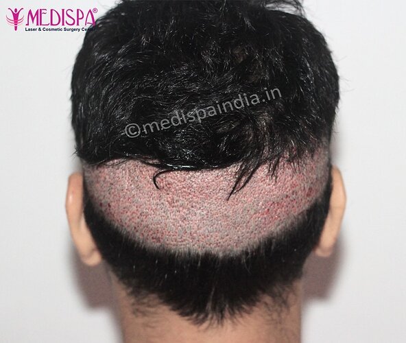 Dr. Suneet Soni - 2500 FUE Grafts, NW- III photo