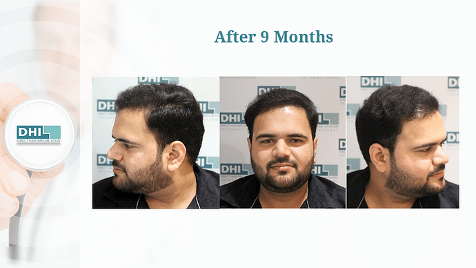 Full Scalp Coverage – 3511 Grafts | DHI India Result photo