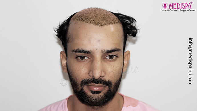 Dr. Suneet Soni - 4046 Grafts | 12-Month Result | Combination FUT + FUE + Beard photo