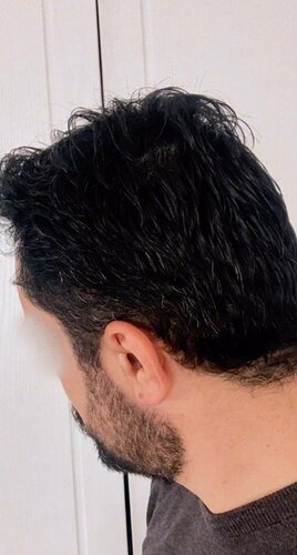 DR HAKAN DOGANAY/ 2000 GRAFTS / Implanter Pen+FUE photo