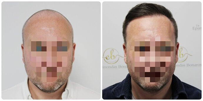 Dr Bonaros, Glasgow, UK / 4076 FUE grafts / 0-12 Months photo