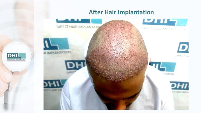 DHI India™ | NW 4 | 3,714 Grafts | 2 Years DHI Hair Transplant Result photo