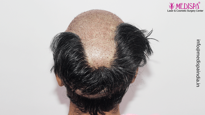 Dr. Suneet Soni - 4889 Grafts | 2.5 Years Result | Combination FUT + FUE + Beard photo