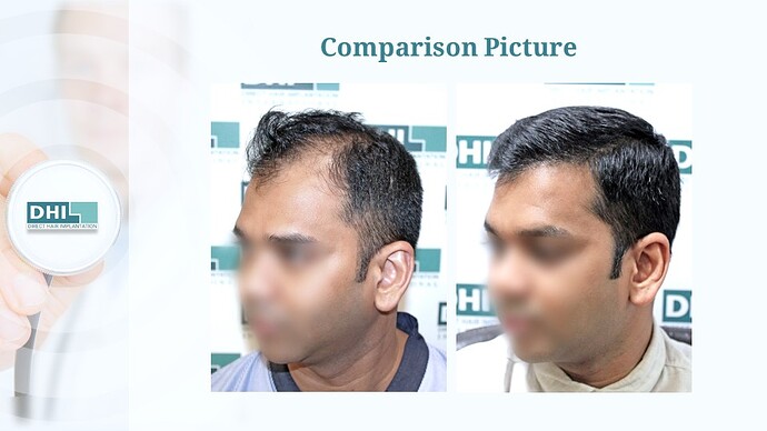 DHI India™ | NW 5 | 3,257 Grafts | 7 Months Hair Transplant Result photo