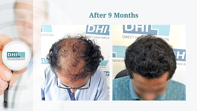 DHI India | NW Scale 6 | 4,127 Grafts | 9 Months DHI Hair Transplant Result photo