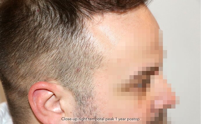 Case performed by Dr. Feriduni – 3726 FU in 1 procedure photo