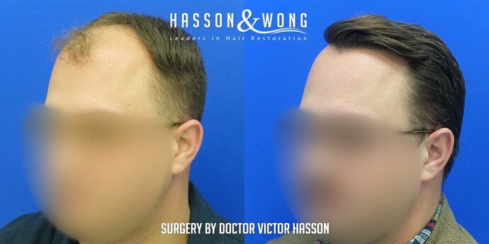 Dr. Hasson / 4,511 grafts / FUE / Frontal zone /mid / 3 years post-op photo