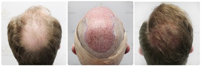 Dr Bonaros, Glasgow, UK / 4081 FUE grafts / 0-12 Months photo