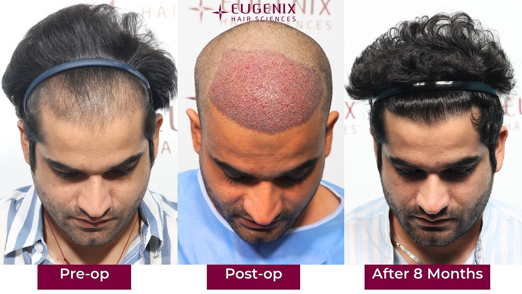 https://cdn.forumhairtransplant.com/optimized/3X/b/2/b29d93647f06ab8e9b086faa9c9200d22a02984c_2_1035x582.jpeg