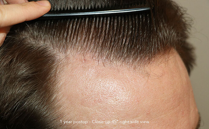 Case performed by Dr. Feriduni – 3322 FU in 1 procedure photo