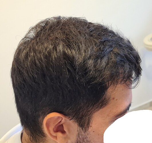 FUE Hair Transplant Result for 3100 Grafts - NW3 – 8 Months After – HDC Hair Clinic photo