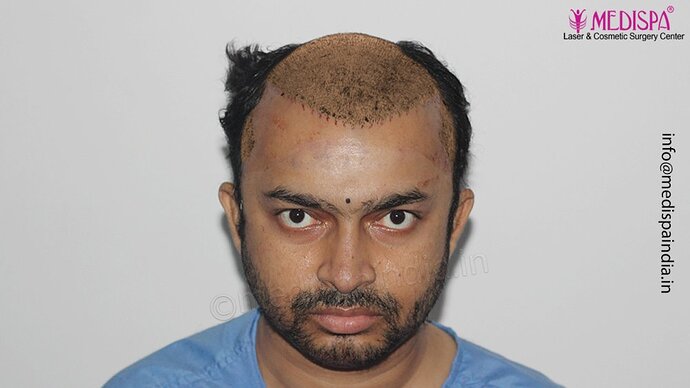 Dr. Suneet Soni - 5000 Grafts, Combine FUT + FUE + Beard Technique, NW-V photo
