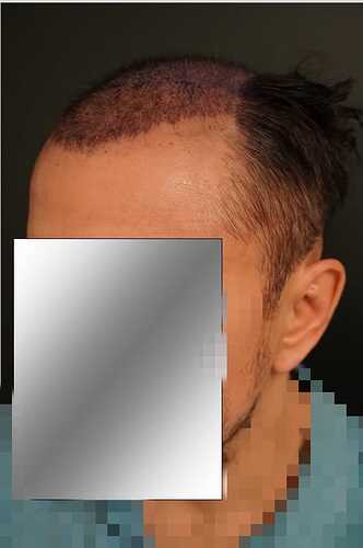 Hattingen Hair Clinic, 4 435: 4 093 FUT and 342 FUE. photo