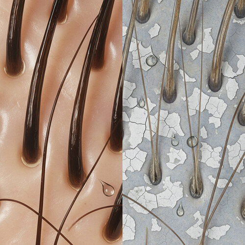 Comparison of hydrated versus dehydrated scalp and hair follicles.