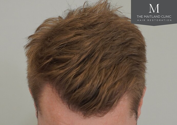 Dr Ball - The Maitland Clinic 1204 Grafts By FUE photo