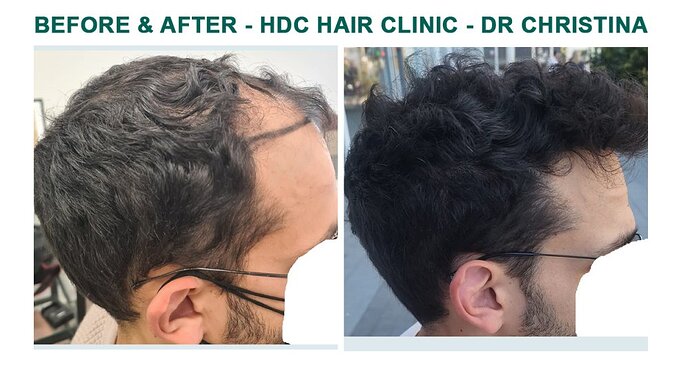 FUE Result for 3000 Grafts – NW Class 3 – Wavy hair – HDC Hair Clinic – Dr Christina photo