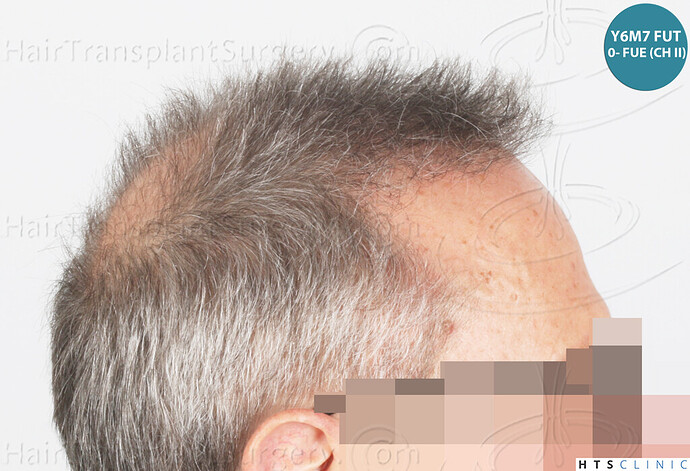 Dr Devroye + Dr Montesanti + Dr Jenard / 7015 grafts (4512 FUT + 2503 FUE) / 2 sessions photo