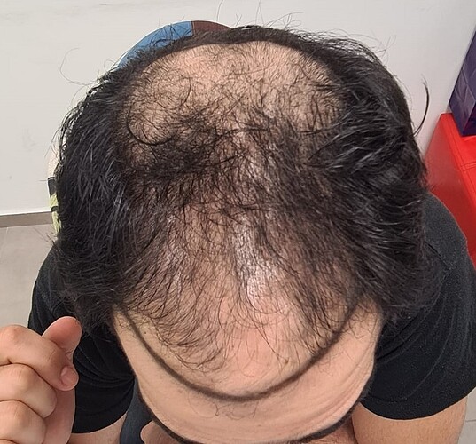 17 Months after 3320 FUE Grafts – Dr Christina – HDC Hair Clinic photo