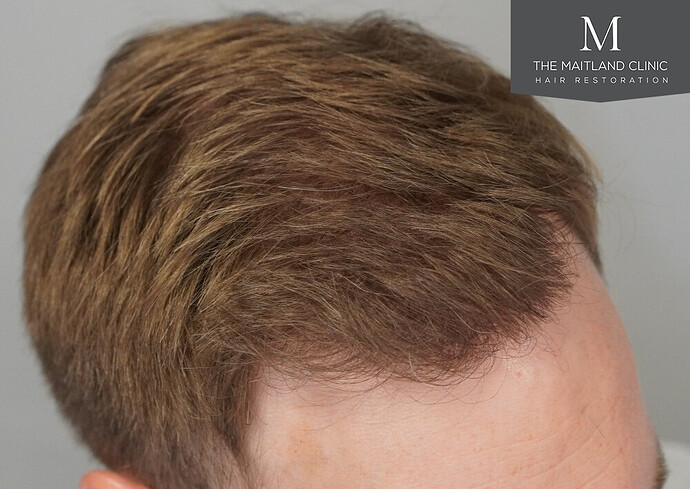 1826 grafts by FUE with Dr Edward Maitland Ball at The Maitland Clinic photo
