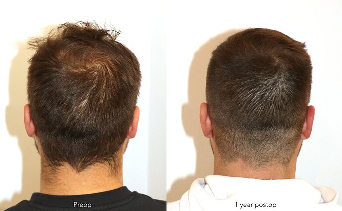 Case performed by Dr. Feriduni – 3726 FU in 1 procedure photo
