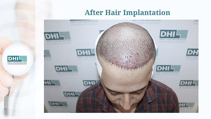 DHI India™ | NW 5 | 3,323 Grafts | 1 Year Hair Transplant Result photo