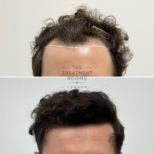 FUE Hairline Restoration 1306 Grafts- The Treatment Rooms London photo