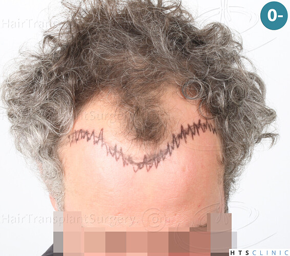 Dr Devroye + Dr Montesanti + Dr Jenard, HTS Clinic / 2932 FUE / Hairline & frontal area photo