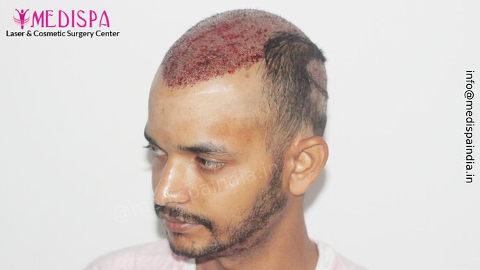 Dr. Suneet Soni - 5294 Grafts, Combine FUT + FUE + Beard Technique, NW- VI, 2 Years Result photo