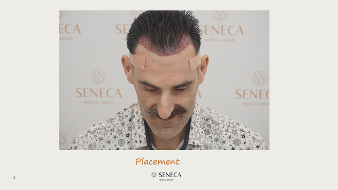 Seneca Medical Group - 1500 grafts with Direct Fue photo